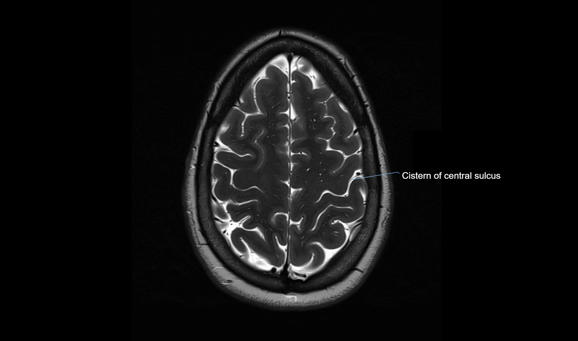 Brain cisterns  and ventricles  axial anatomy 3T MRI image-img-00001-00047.webp